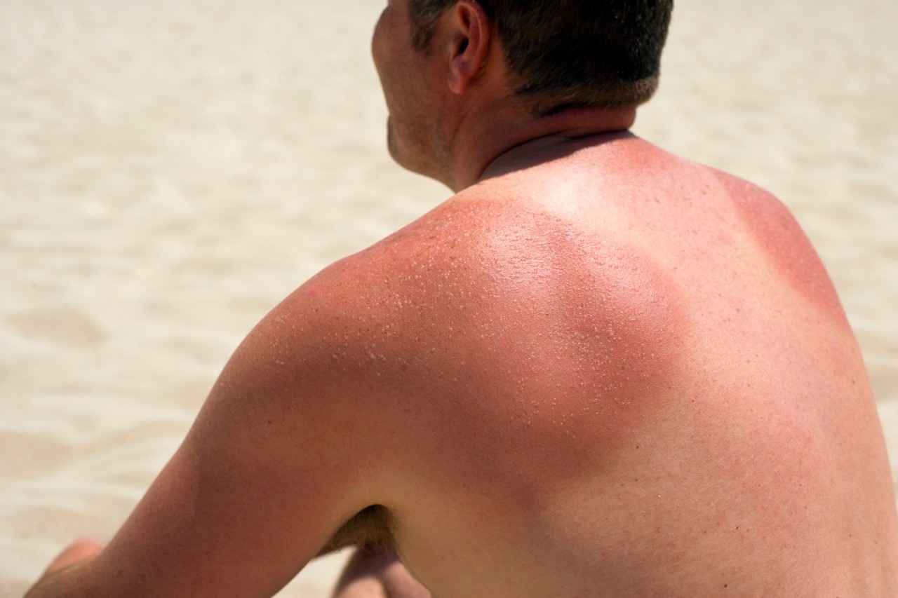 Sunburn --- Image by © IAN HOOTON/Science Photo Library/Corbis