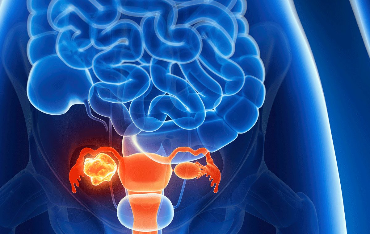 Signs and Symptoms of Ovarian Cancer