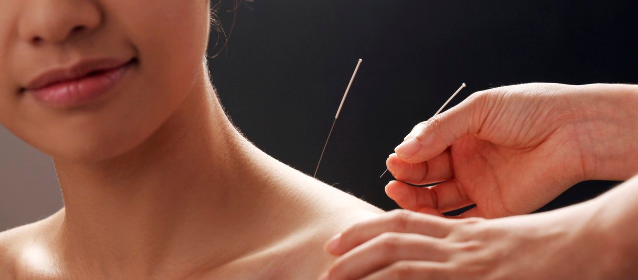 Doctor putting acupuncture needles on woman's shoulder, close-up --- Image by © Viewstock/Corbis
