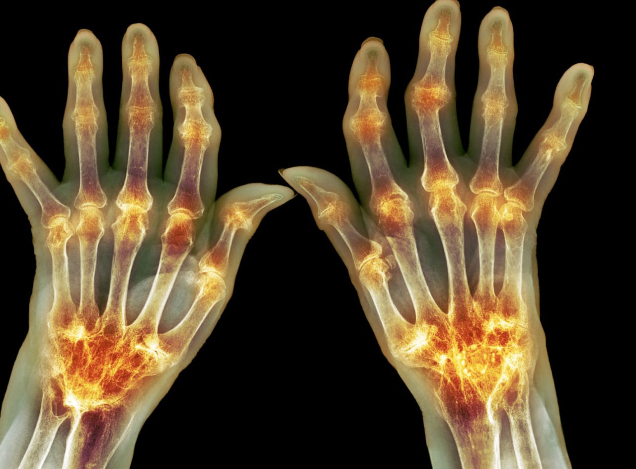 How to Explain Rheumatoid Arthritis to Family and Friends