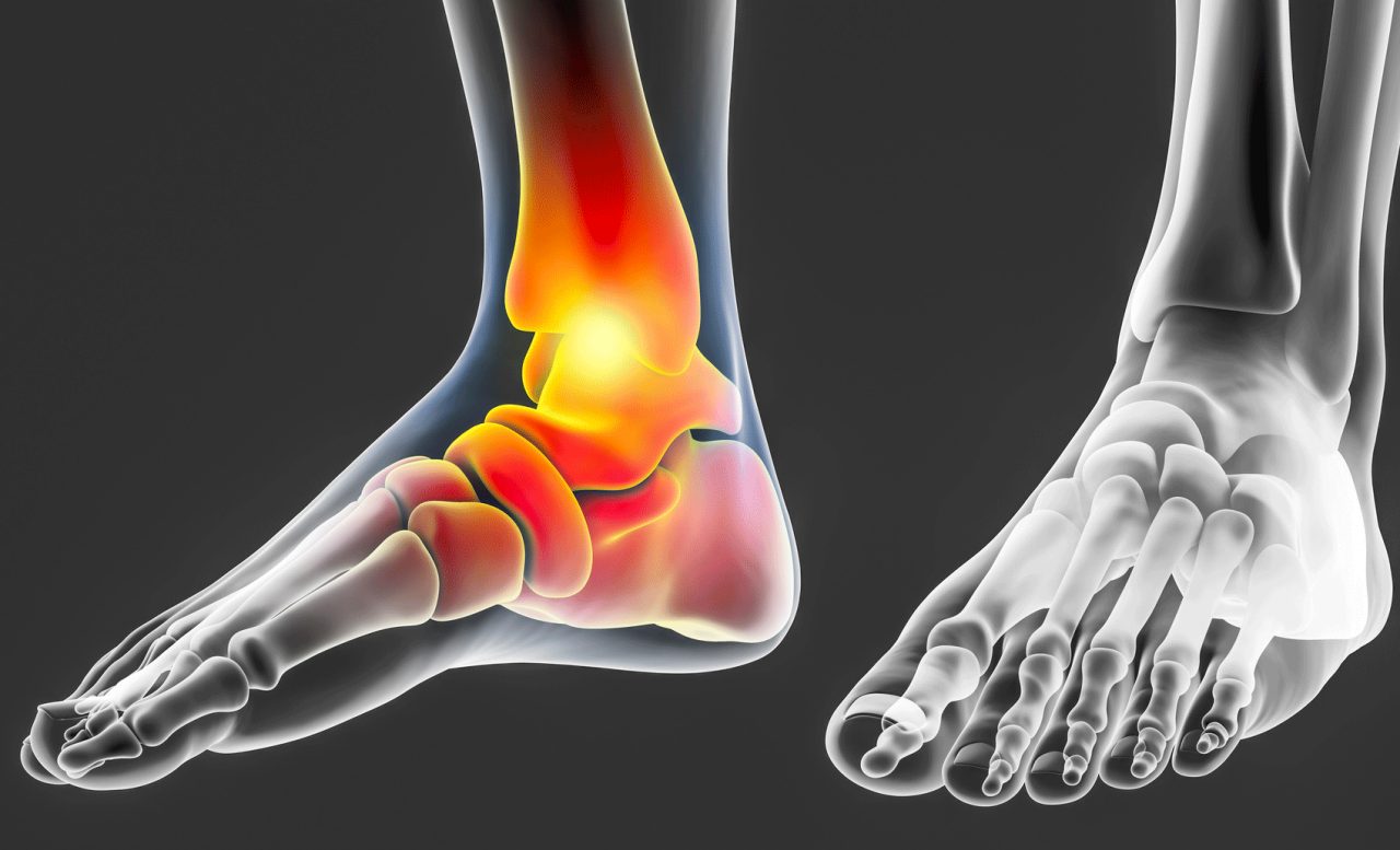 Symptoms, Causes, Treatment, and Prevention of Tendonitis