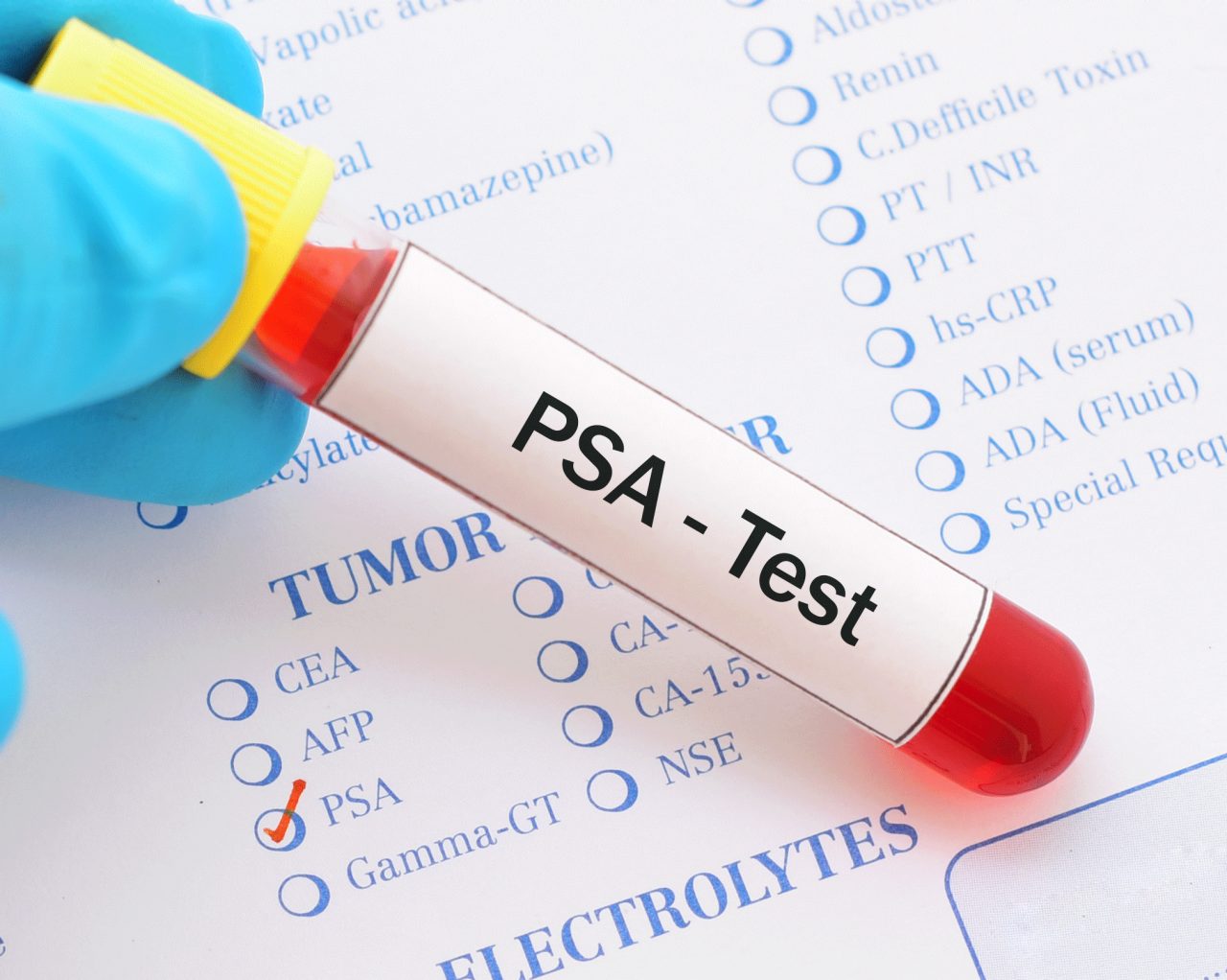 What Is a PSA Test?