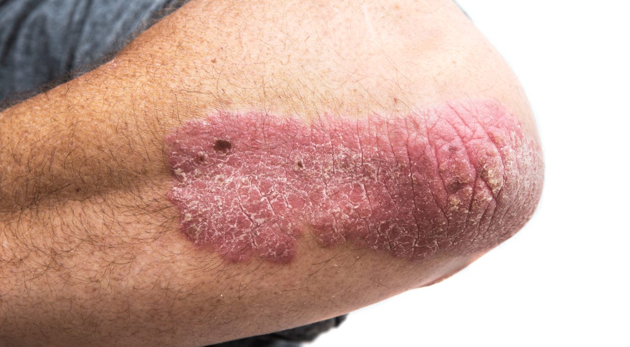 Better Treatment for Psoriasis