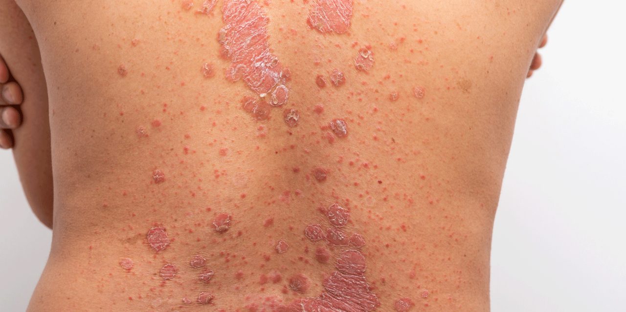 What Is Eczema?