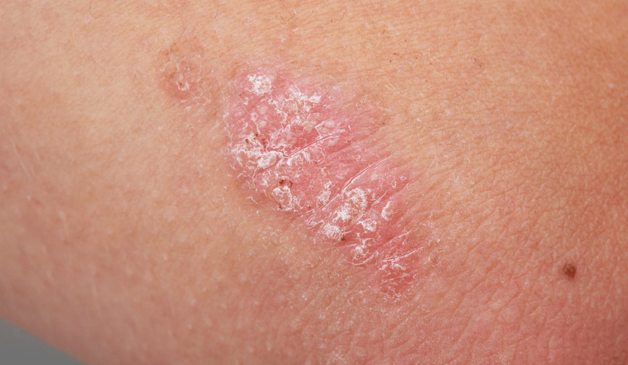 What Is Psoriasis?