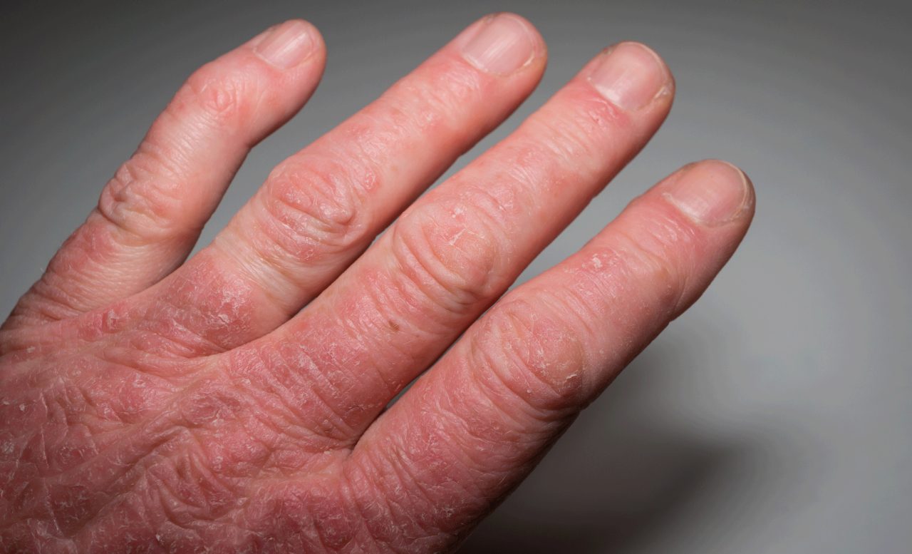 What Is Psoriatic Arthritis? 