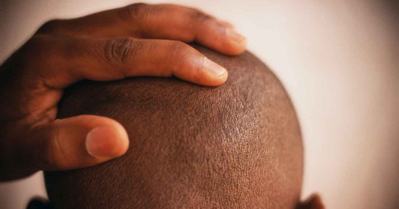 What Is the Best Treatment for Thinning Hair? YourCareEverywhere