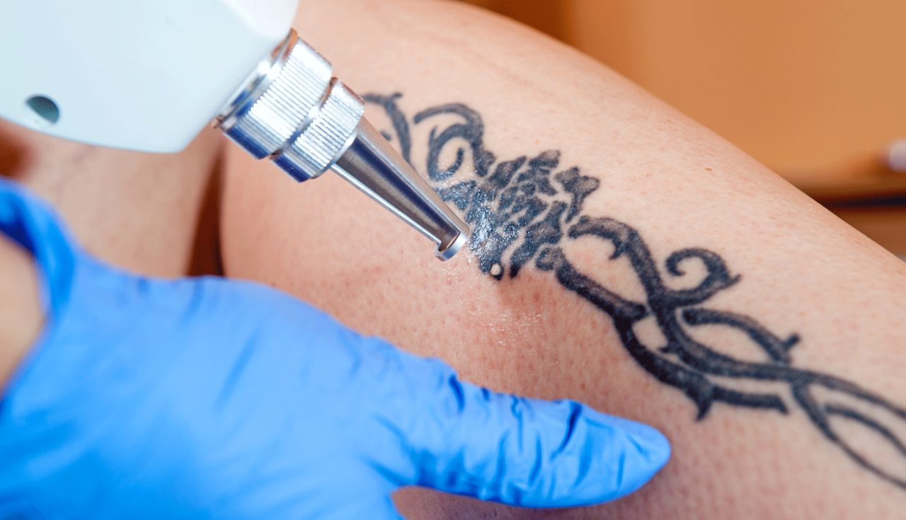 What to Know About Tattoo Removal 