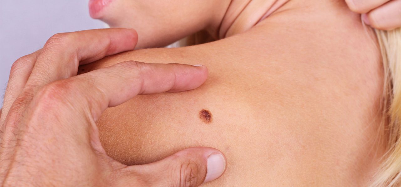 How Is Nonmelanoma Skin Cancer Treated?