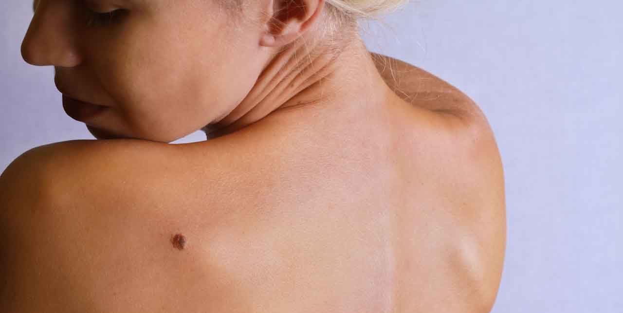 Know Early Melanoma Symptoms