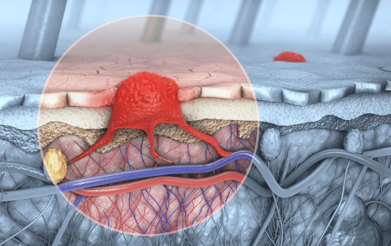 What Does Skin Cancer Look Like?