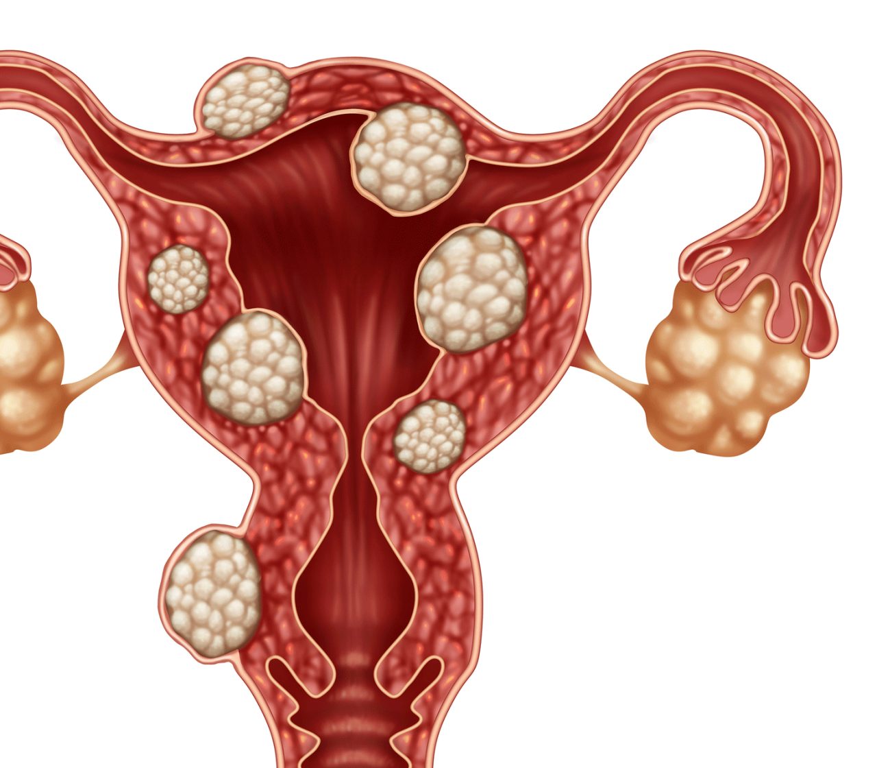 Symptoms of Uterine Fibroids