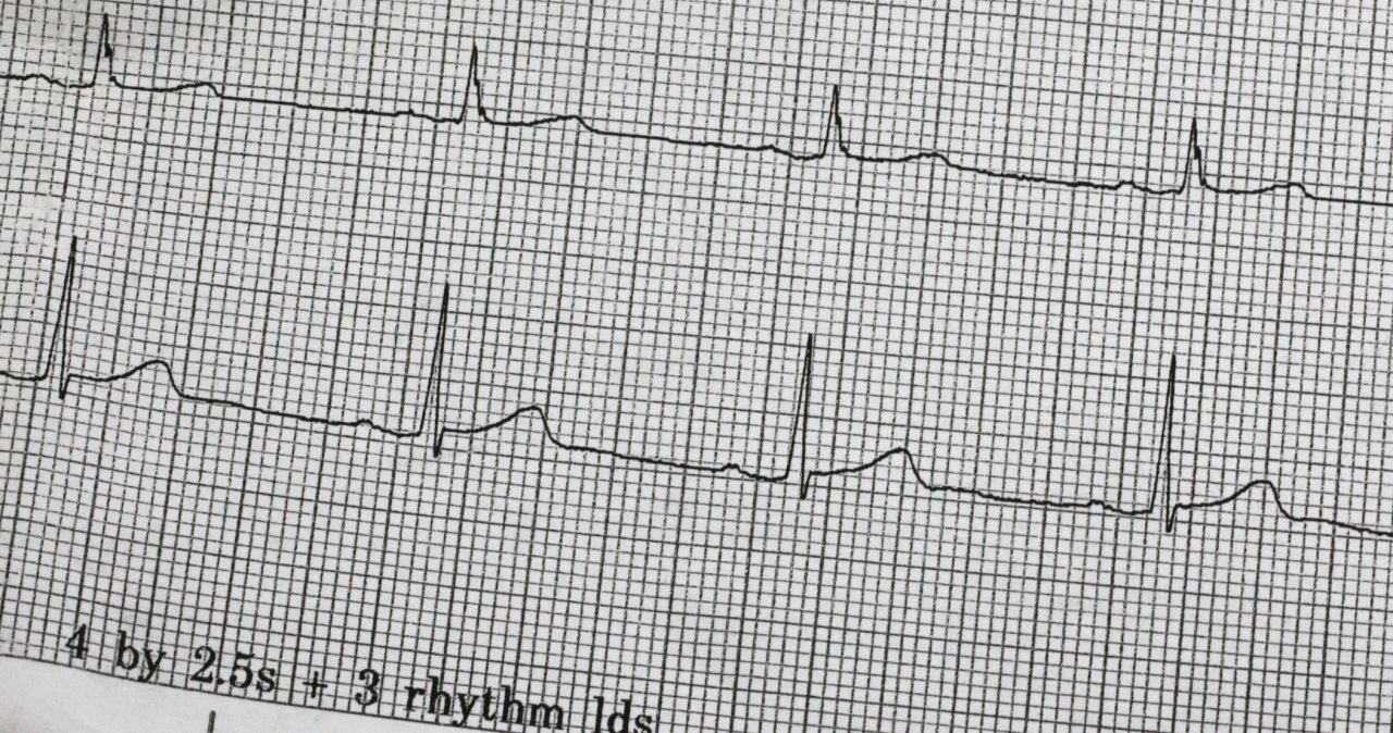 What Is Cardiac Catheter Ablation?