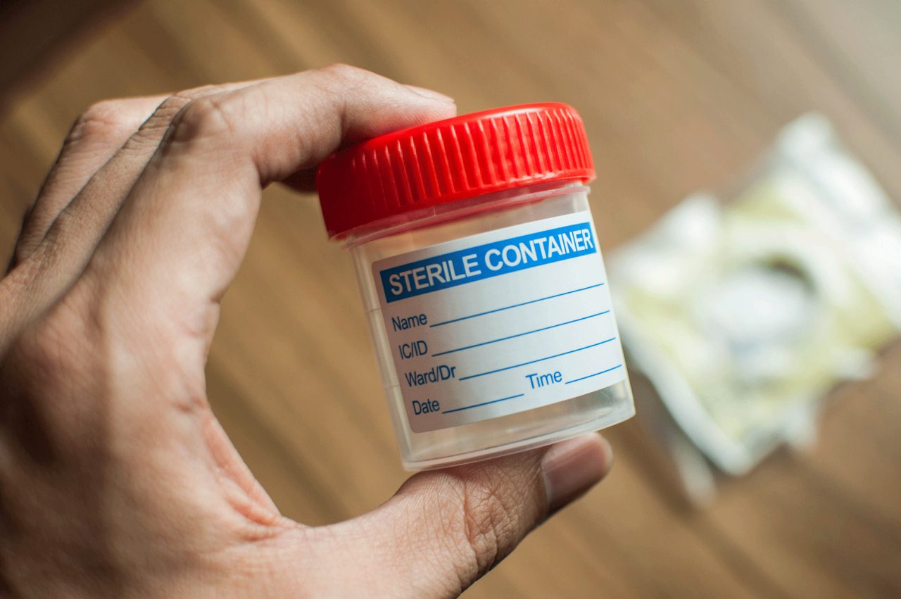 Why Your Healthcare Provider Asks for a Urine Sample