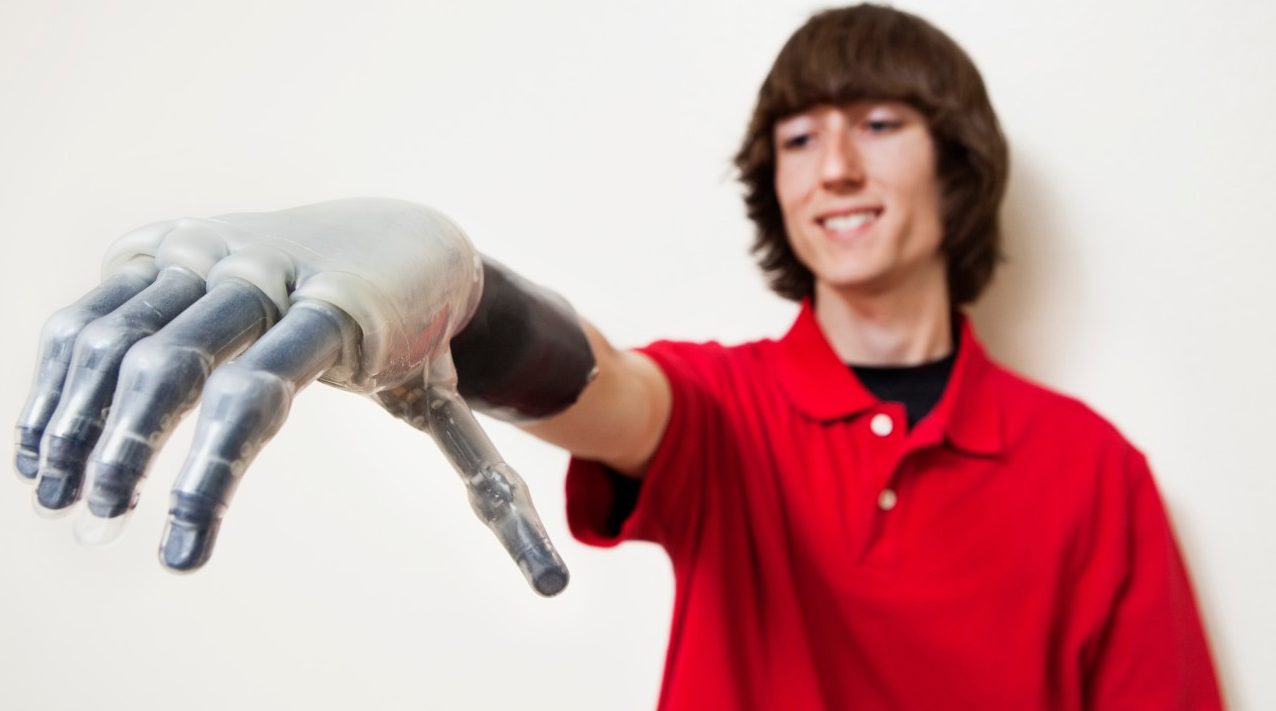 Modern Prosthetic Hands Are More Advanced