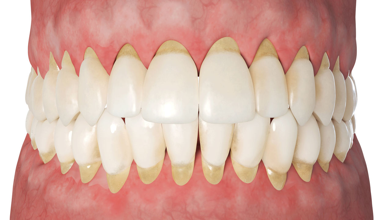 What Is Periodontitis?