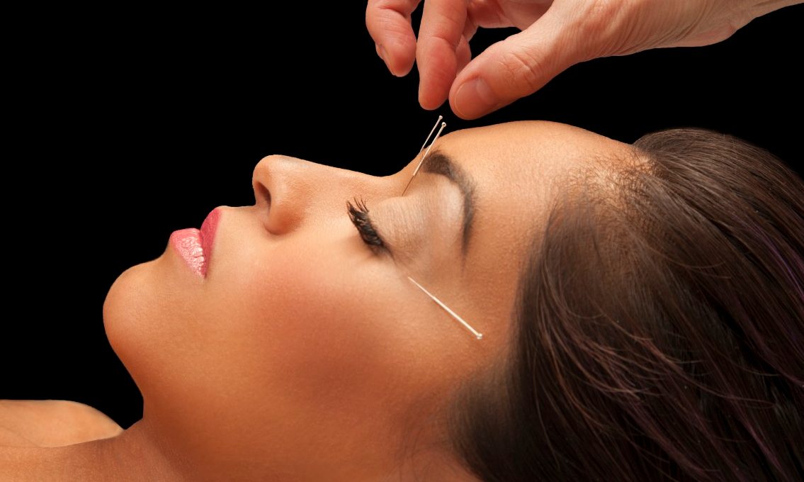 Young woman getting acupuncture treatment for health and beauty --- Image by © Becky Yee/Corbis